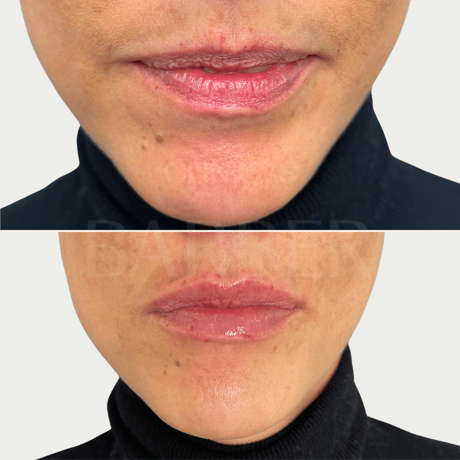 correccion de asimetria en labios