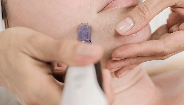 dermapen, microagujas, microneedling, calidad de piel